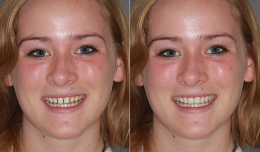 Smile Makeovers