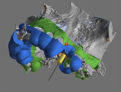 CBCT