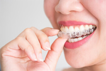 Essix Retainer