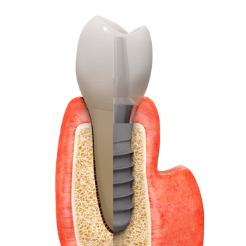 Implant Tooth