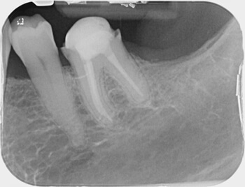 Post Root Canal treatment and Crown