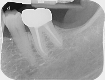 Post-Op and Ceramic Crown